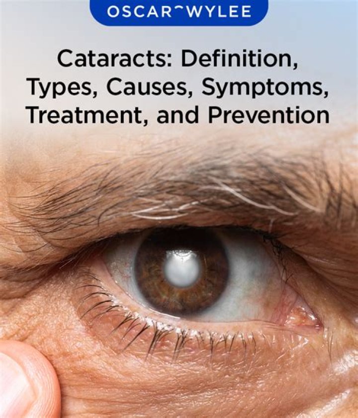 Can cataracts be caused by stress