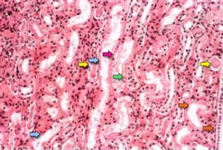 Is acute tubular necrosis painful