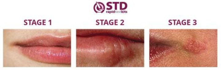 What are herpes prodrome symptoms