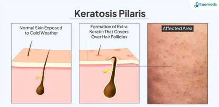 What causes keratosis on the skin